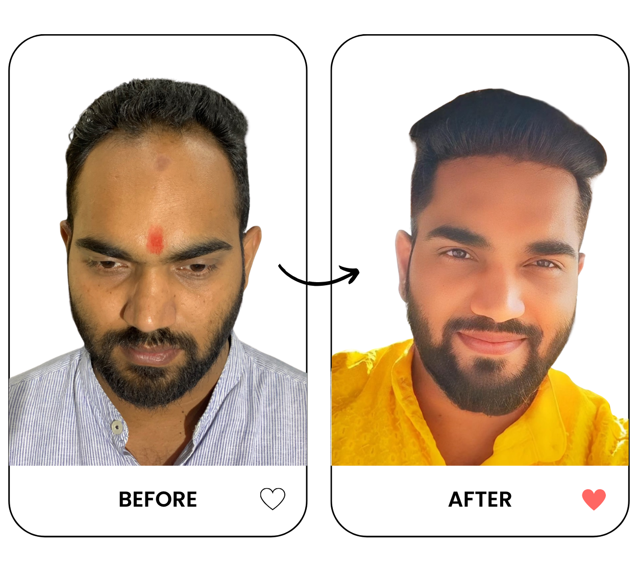 hair-transplant